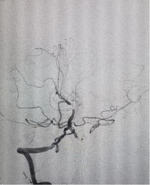 神经内科联合多学科团队成功救治急性期基底动脉尖栓塞脑梗死患者